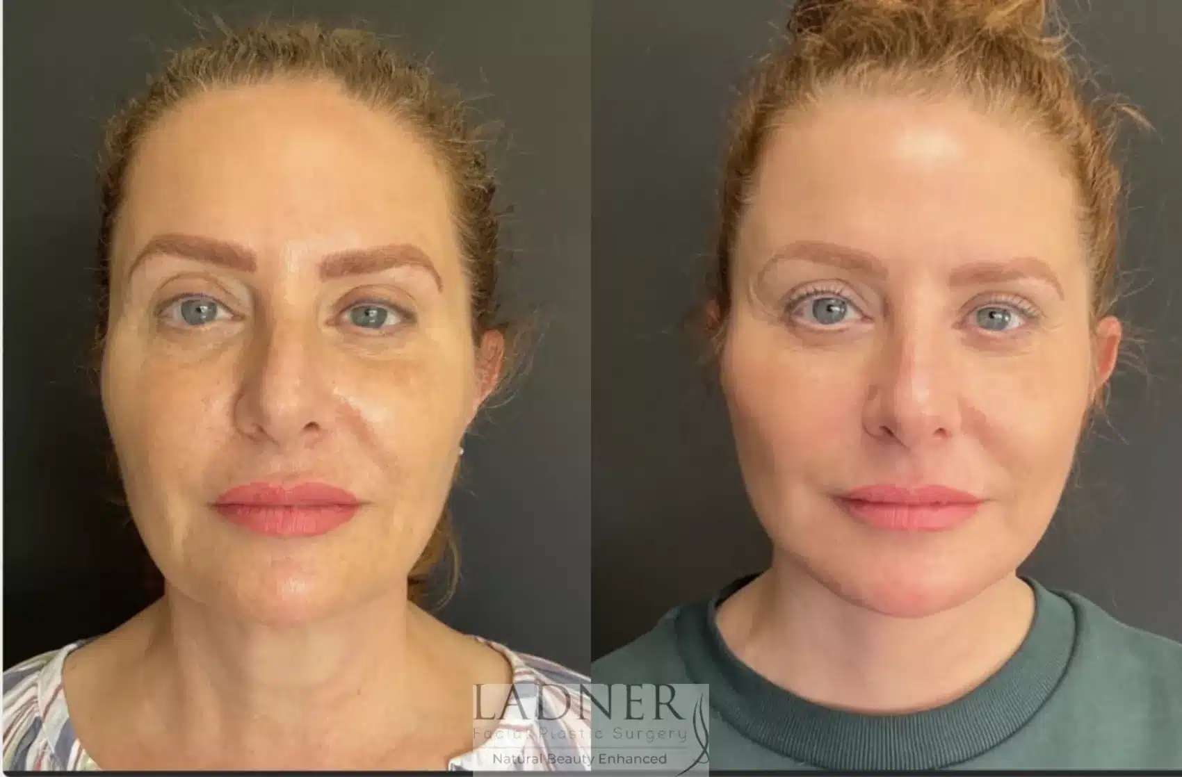 Before and After Image: Facial Fat Transfer - front