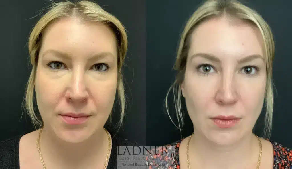Before and After Image: Lower Blepharoplasty, Minimally Invasive Neck Tightening, Facial Fat Transfer, and Buccal Fat Removal - front