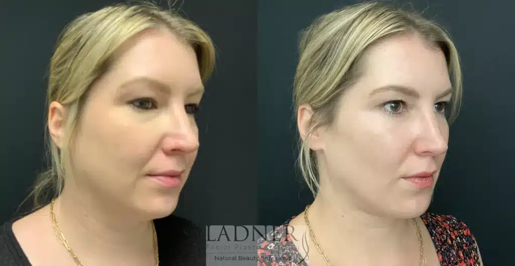 Before and After Image: Lower Blepharoplasty, Minimally Invasive Neck Tightening, Facial Fat Transfer, and Buccal Fat Removal - right-front-oblique