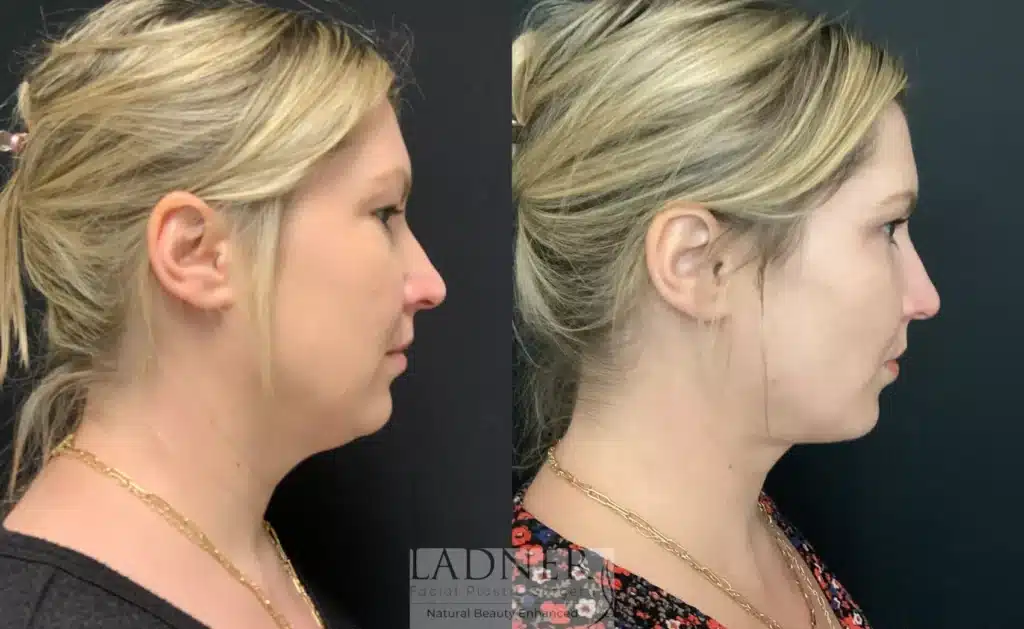 Before and After Image: Lower Blepharoplasty, Minimally Invasive Neck Tightening, Facial Fat Transfer, and Buccal Fat Removal - right-side