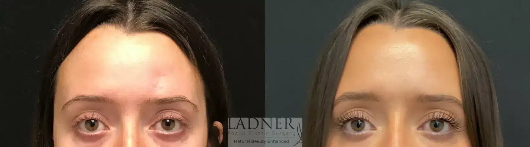 Before and After Image: Facial Fat Transfer - front