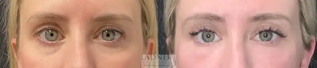 Before and After Image: Facial Fat Transfer - front
