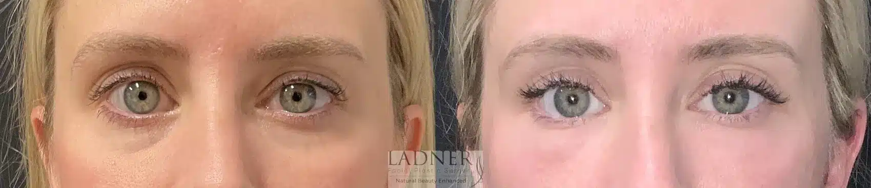 Before and After Image: Facial Fat Transfer - front