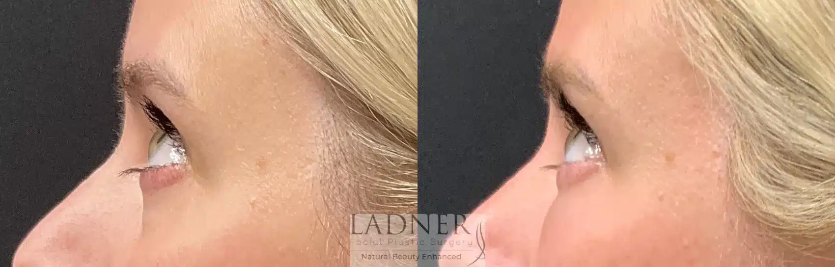 Before and After Image: Facial Fat Transfer - left-side