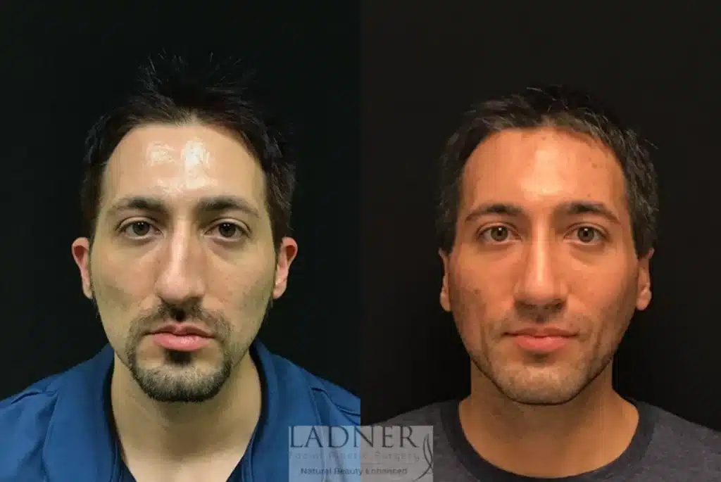 Before and After Image: Rhinoplasty, Chin Augmentation, Ear Surgery, and Facial Plastic Surgery for Men - front