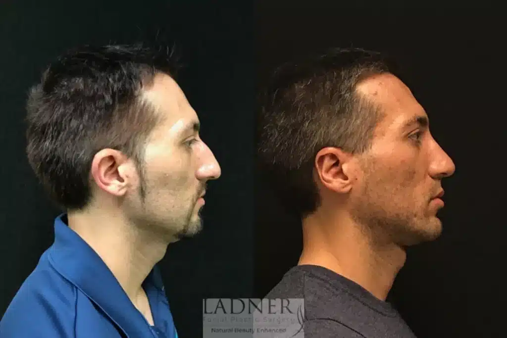 Before and After Image: Rhinoplasty, Chin Augmentation, Ear Surgery, and Facial Plastic Surgery for Men - right-side
