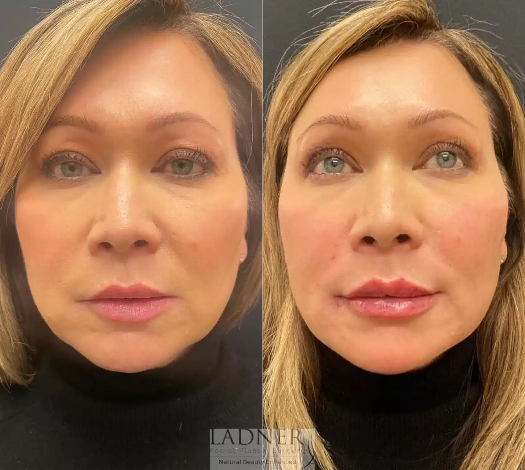 Before and After Image: Lip Fillers - front