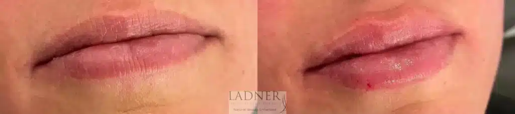 Before and After Image: Lip Fillers - front