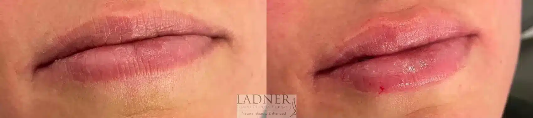 Before and After Image: Lip Fillers - front