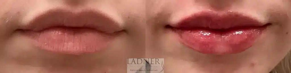 Before and After Image: Lip Fillers - front