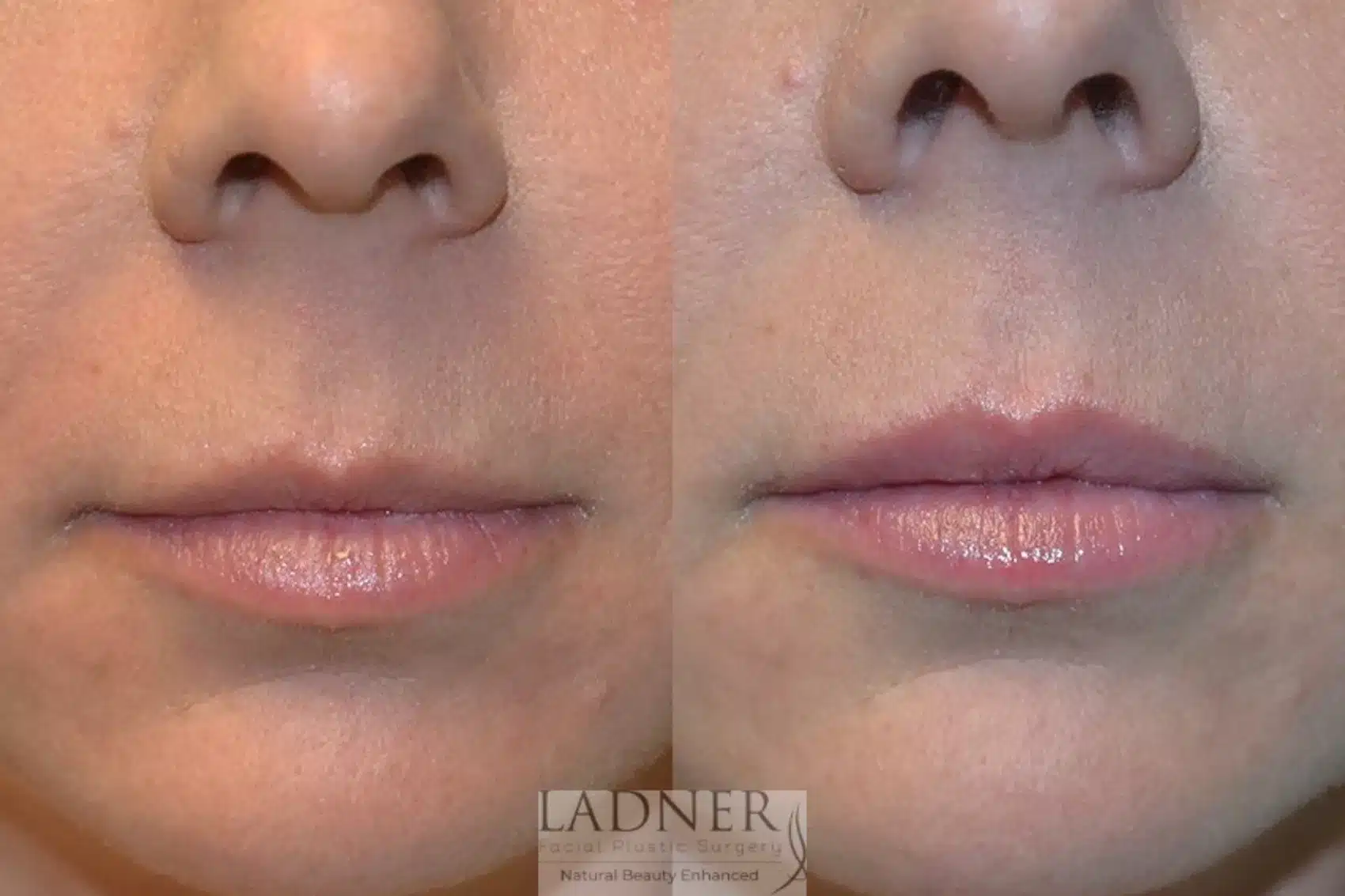 Before and After Image: Lip Fillers - front