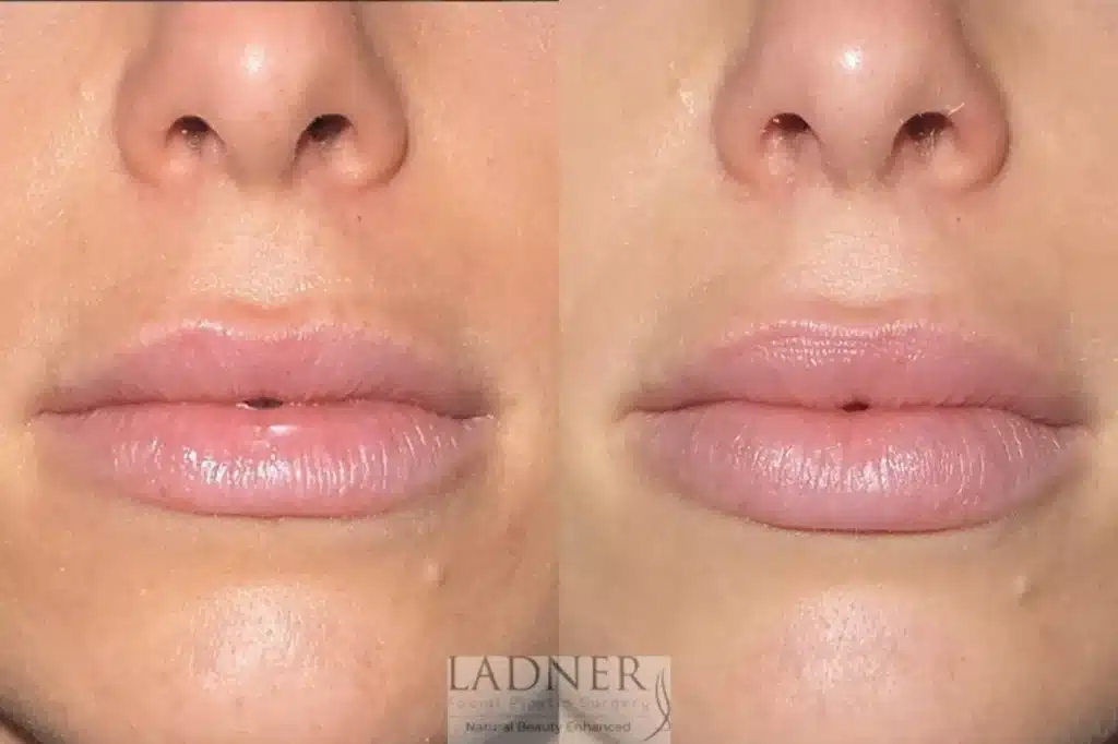 Before and After Image: Lip Fillers - front