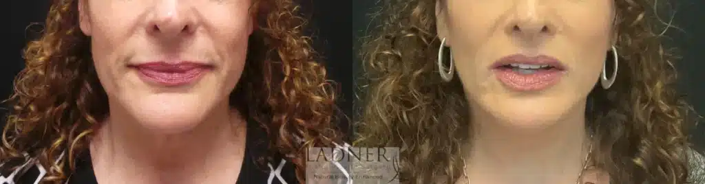 Before and After Image: Deep Plane Facelift/Neck Lift - front