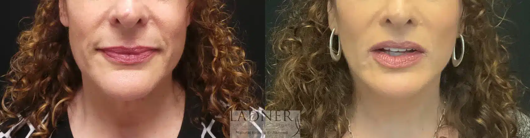 Before and After Image: Deep Plane Facelift/Neck Lift - front