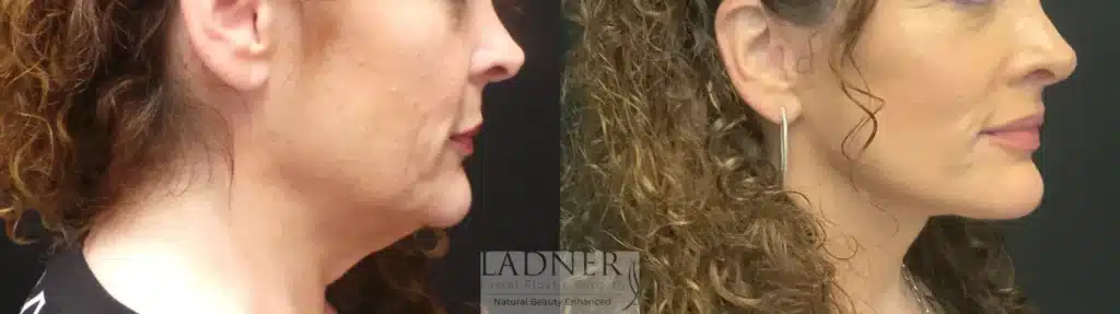 Before and After Image: Deep Plane Facelift/Neck Lift - right-side