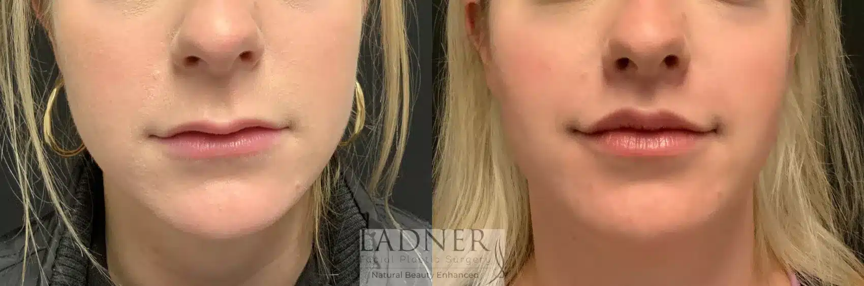 Before and After Image: Lip Lift - front