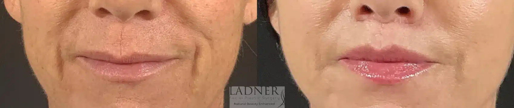 Before and After Image: Lip Lift - front
