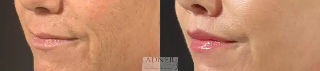 Before and After Image: Lip Lift - left-front-oblique