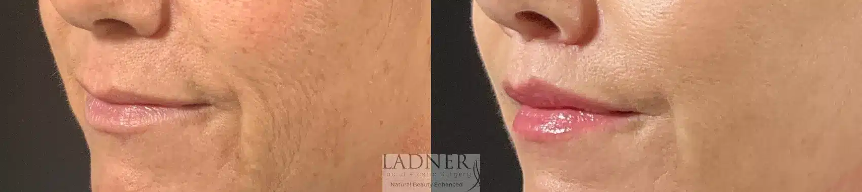 Before and After Image: Lip Lift - left-front-oblique