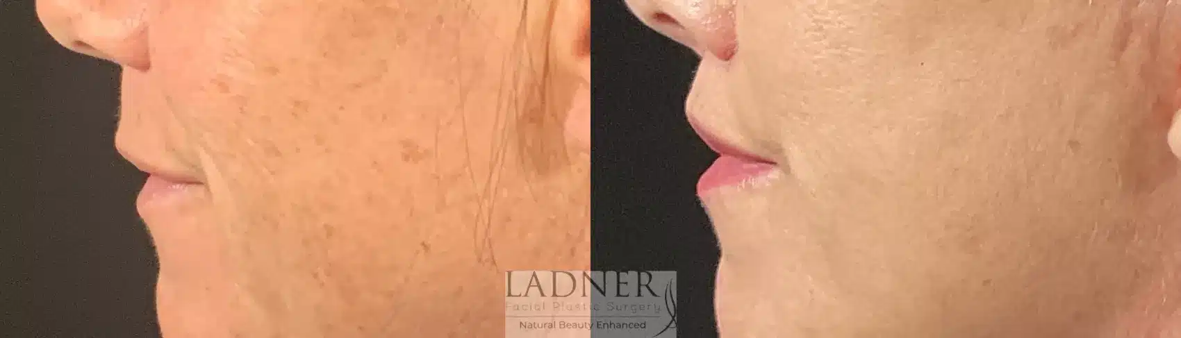 Before and After Image: Lip Lift - left-side