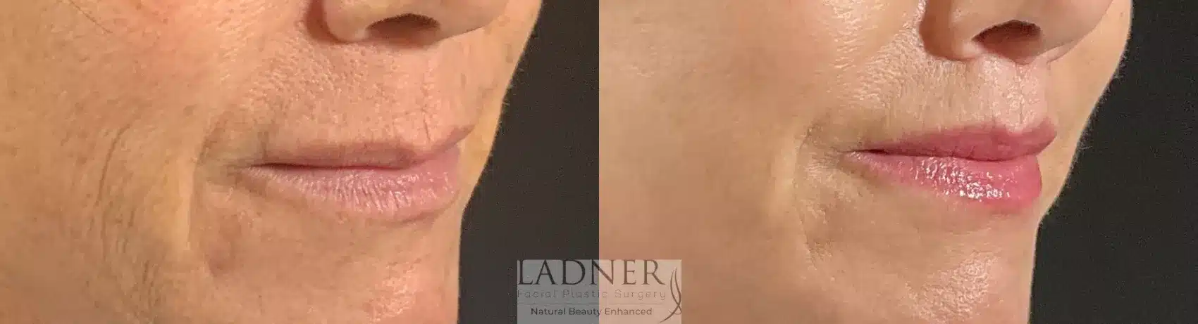 Before and After Image: Lip Lift - right-front-oblique