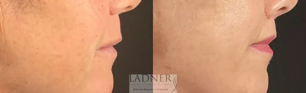 Before and After Image: Lip Lift - right-side