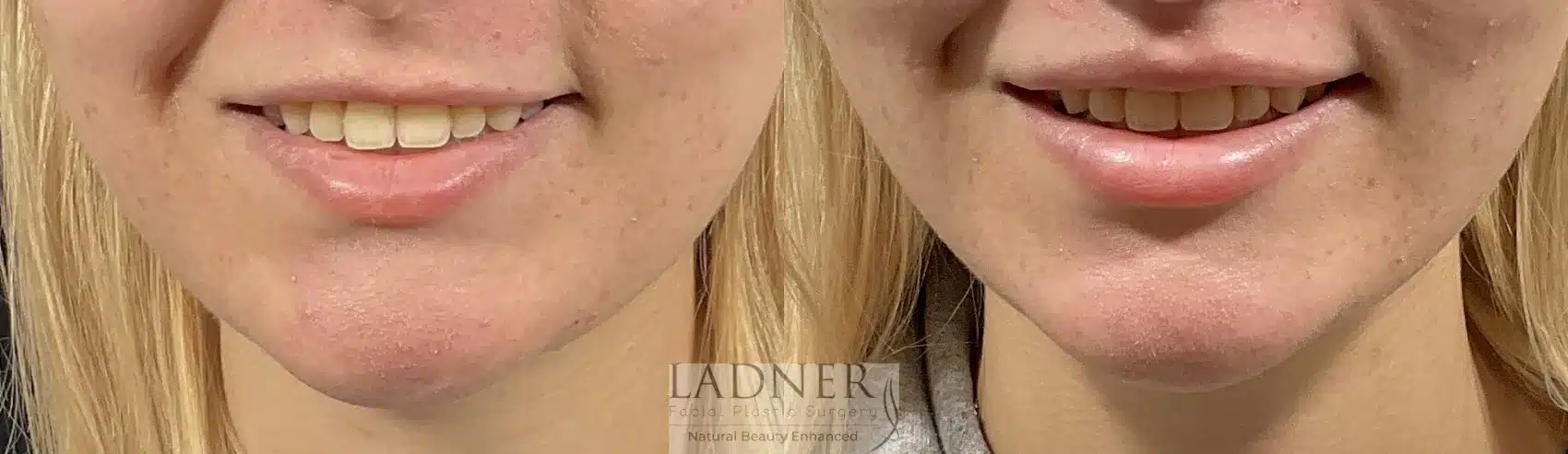 Before and After Image: Lip Lift - front