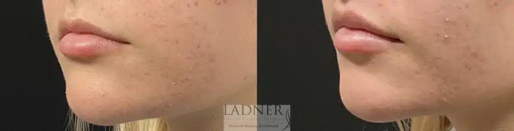 Before and After Image: Lip Lift - left-front-oblique