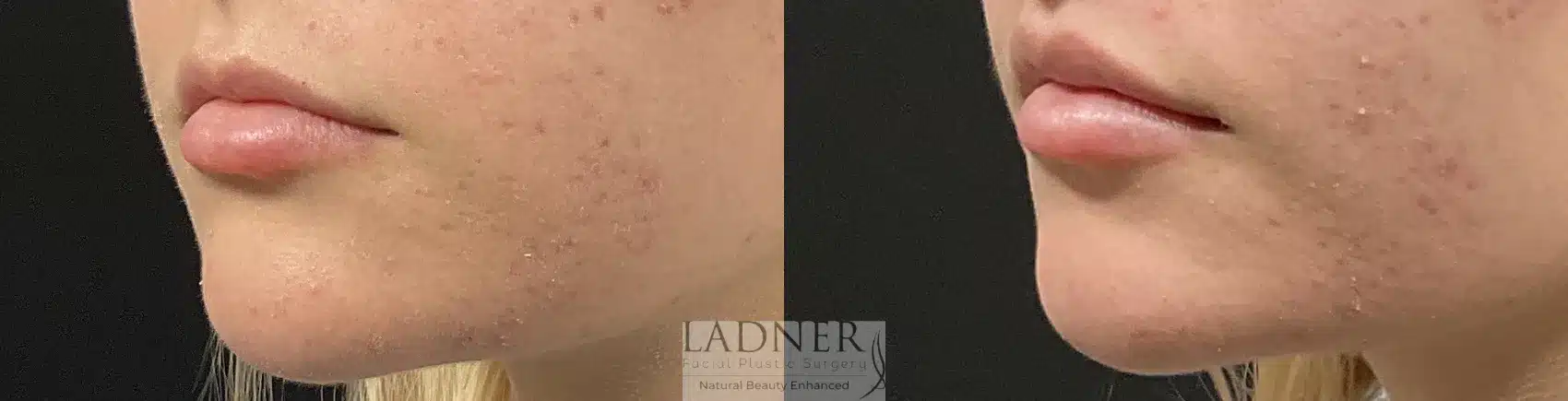 Before and After Image: Lip Lift - left-front-oblique