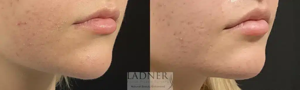 Before and After Image: Lip Lift - right-front-oblique