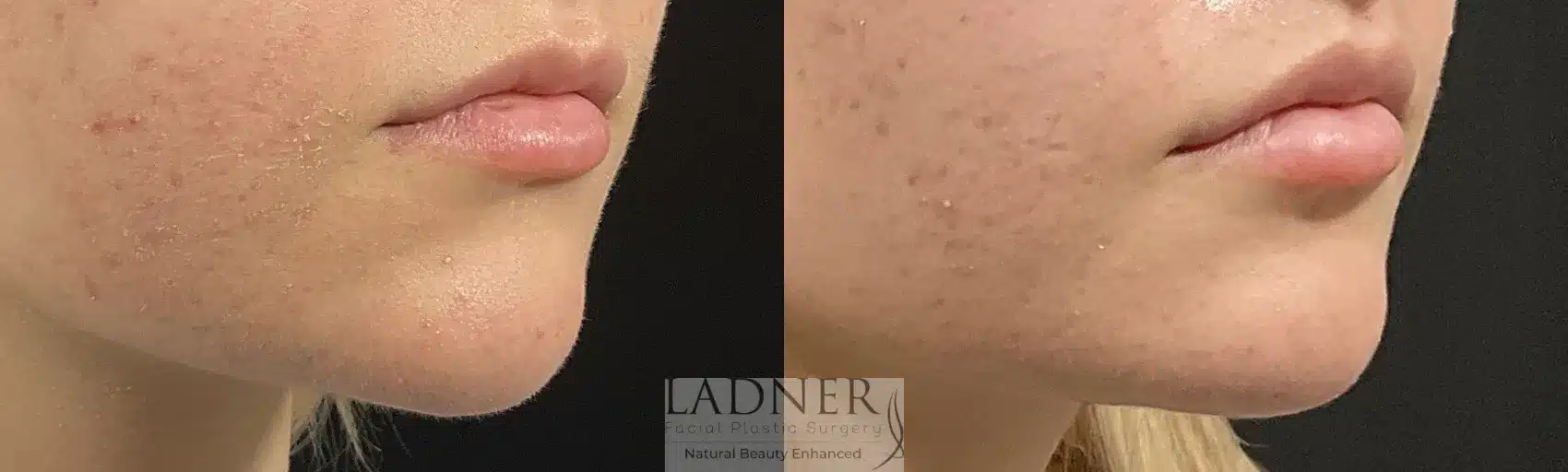 Before and After Image: Lip Lift - right-front-oblique