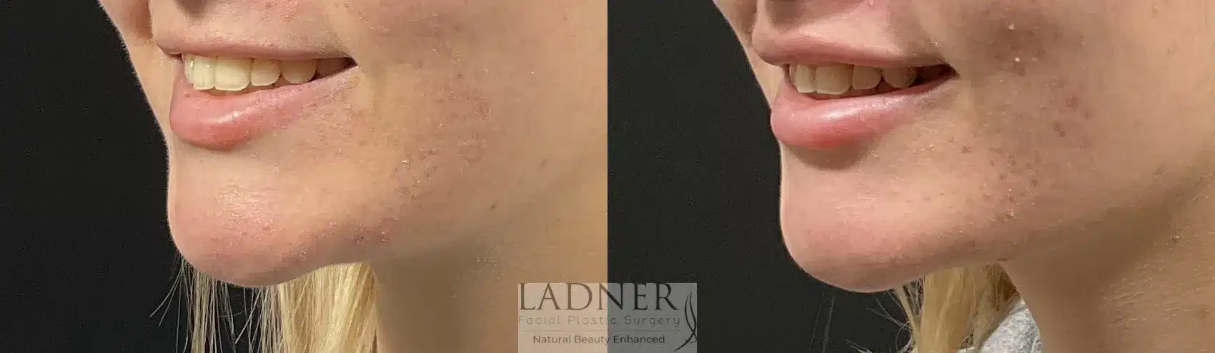 Before and After Image: Lip Lift - left-front-oblique