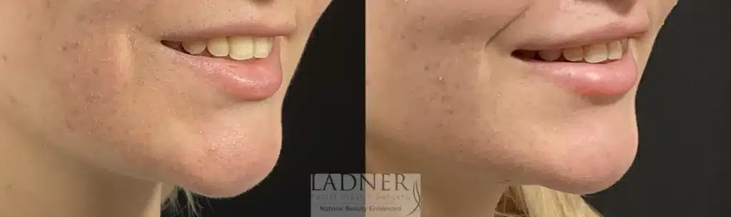 Before and After Image: Lip Lift - right-front-oblique