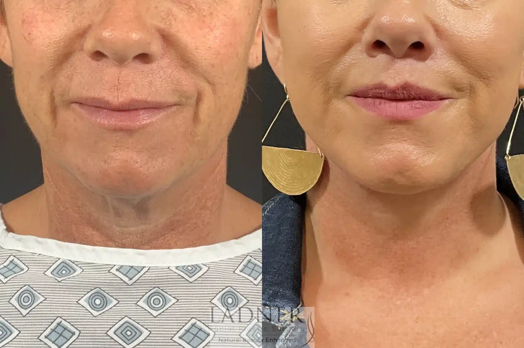 Before and After Image: Lip Lift - front