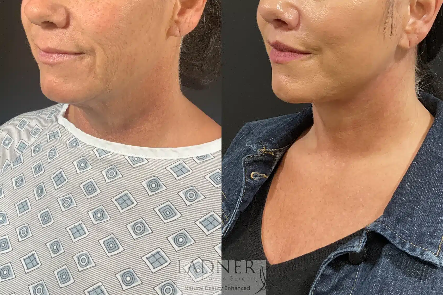 Before and After Image: Lip Lift - left-front-oblique