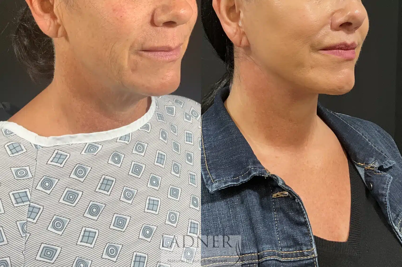 Before and After Image: Lip Lift - right-front-oblique