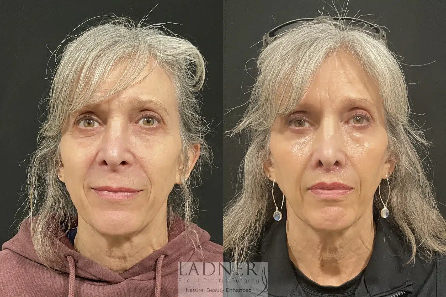 Before and After Image: Lip Lift - front