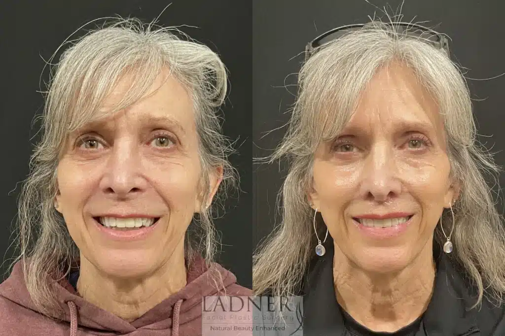 Before and After Image: Lip Lift - 