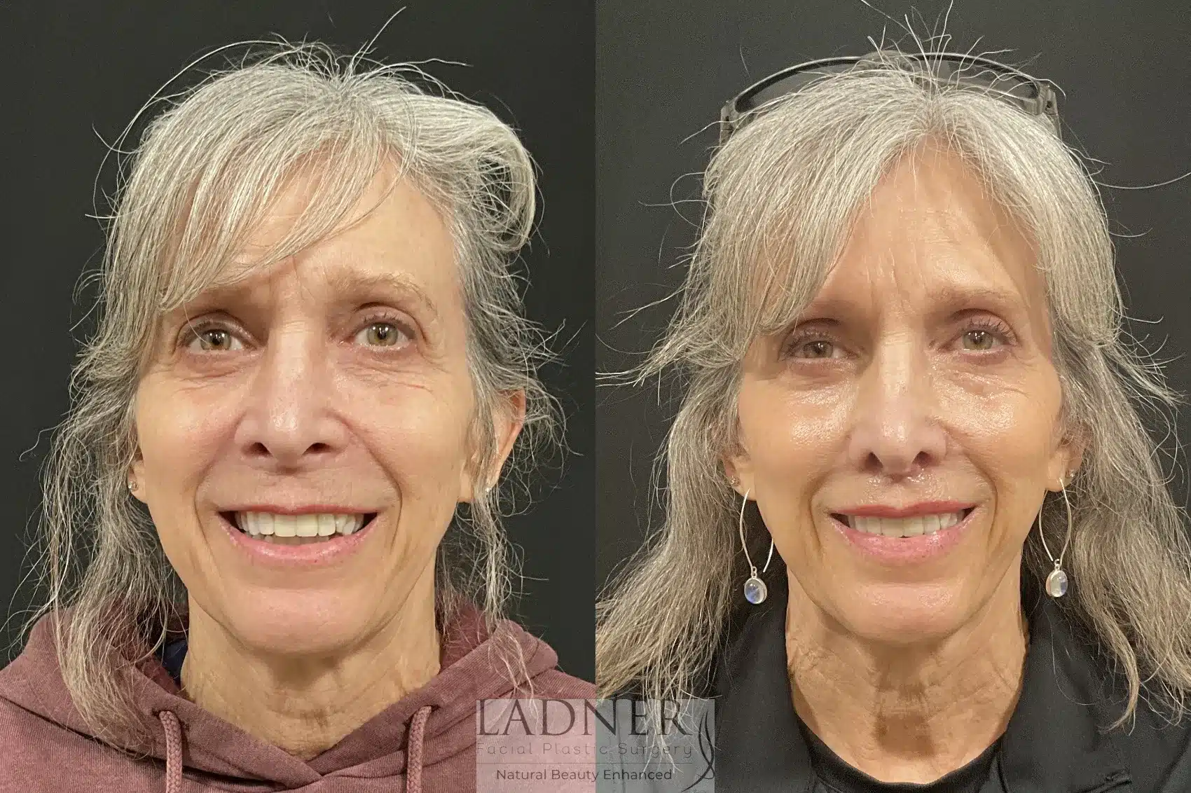 Before and After Image: Lip Lift - 