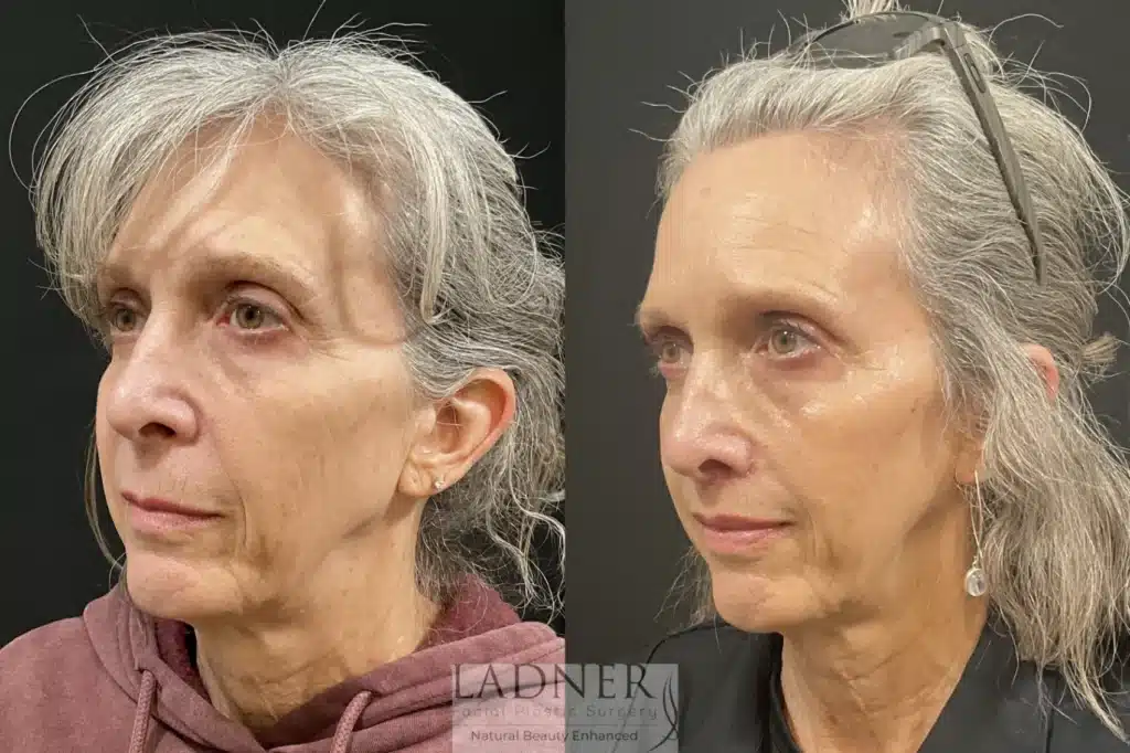 Before and After Image: Lip Lift - left-front-oblique