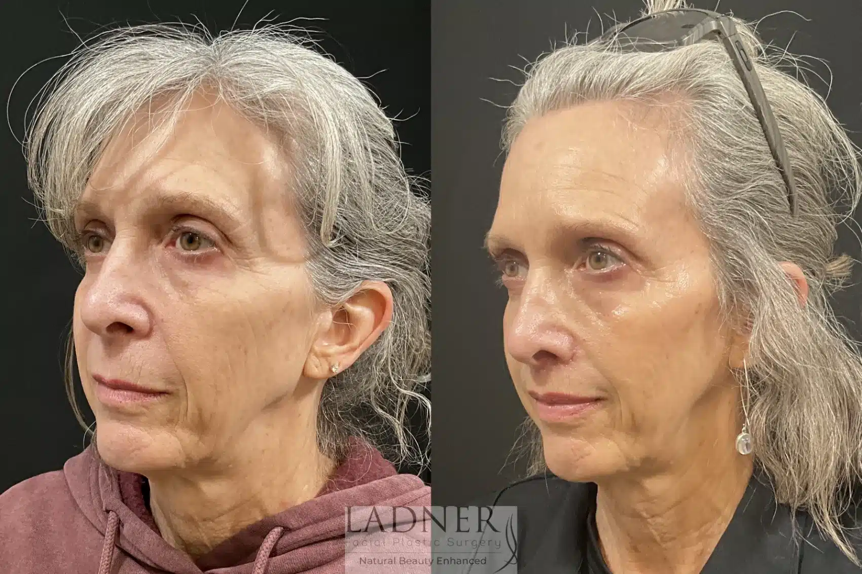 Before and After Image: Lip Lift - left-front-oblique