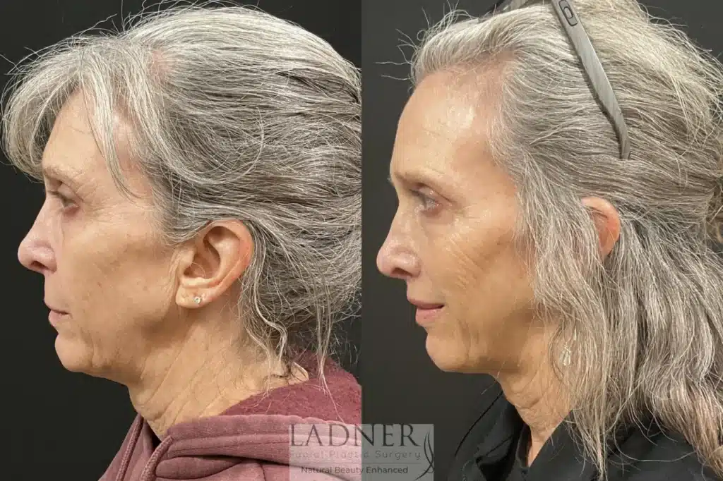 Before and After Image: Lip Lift - left-side