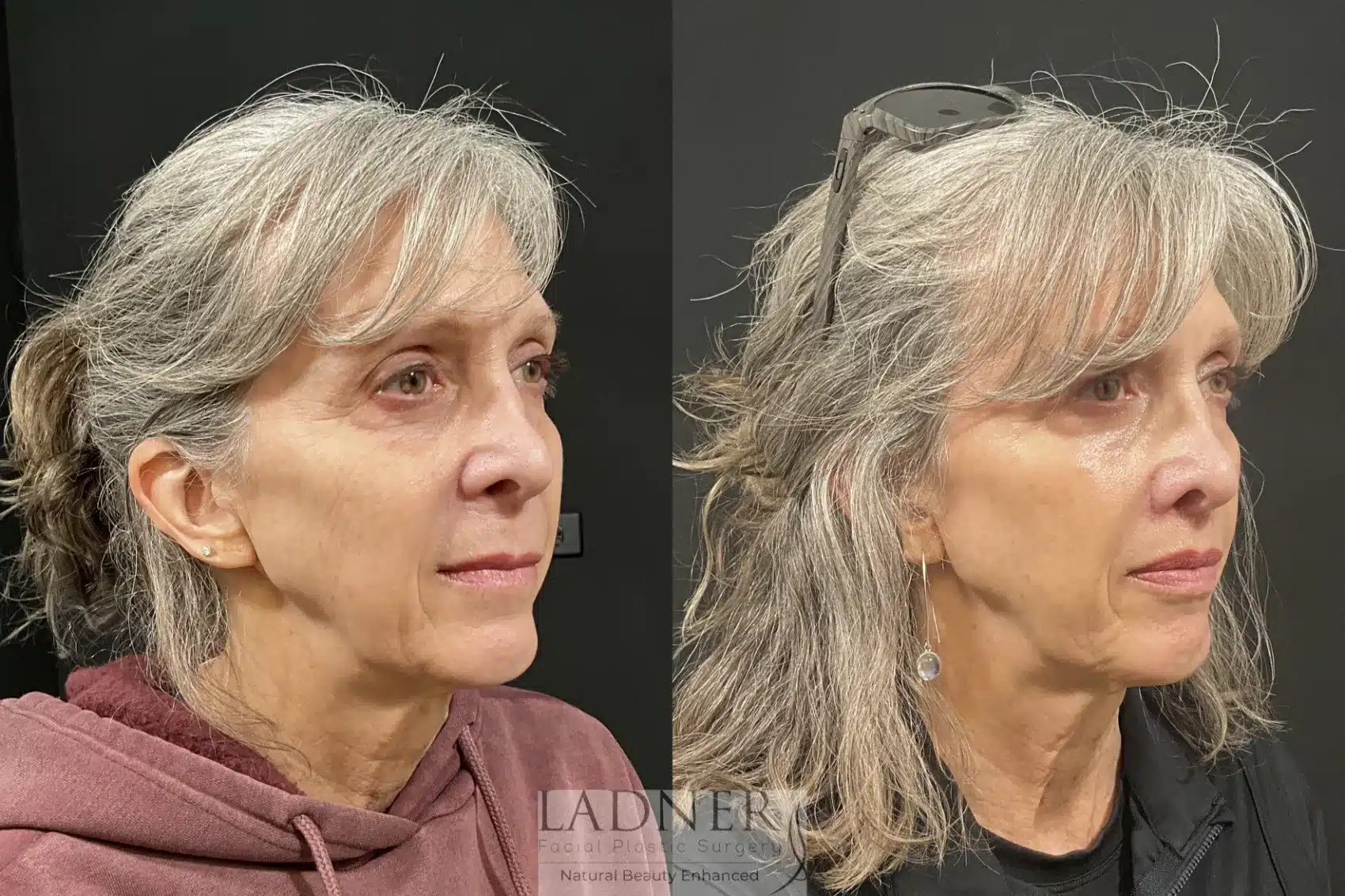 Before and After Image: Lip Lift - right-front-oblique