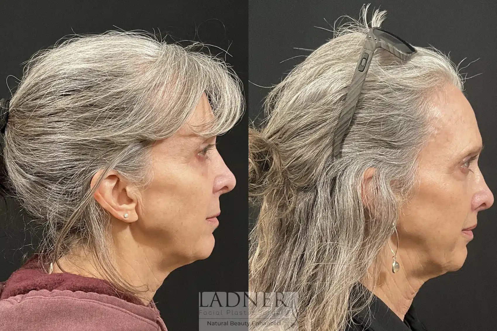 Before and After Image: Lip Lift - right-side