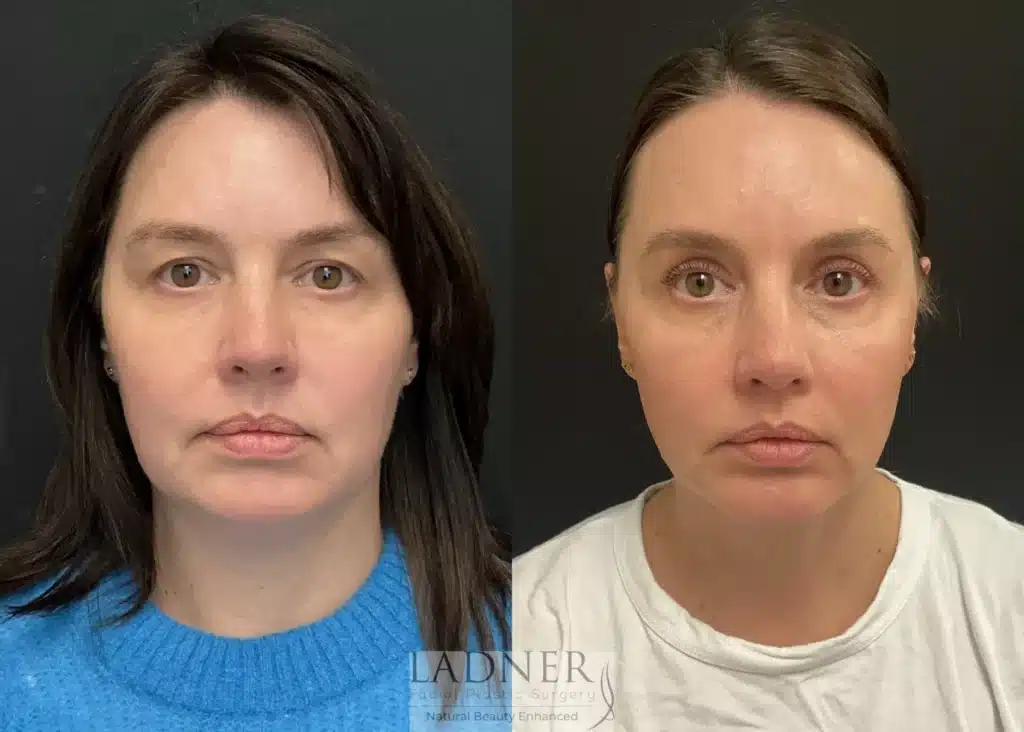 Before and After Image: Blepharoplasty, Minimally Invasive Neck Tightening, and Chin Augmentation - front