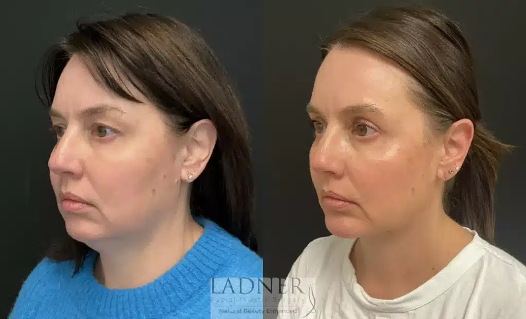 Before and After Image: Blepharoplasty, Minimally Invasive Neck Tightening, and Chin Augmentation - left-front-oblique