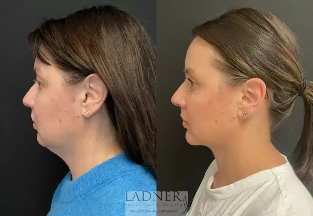 Before and After Image: Blepharoplasty, Minimally Invasive Neck Tightening, and Chin Augmentation - left-side