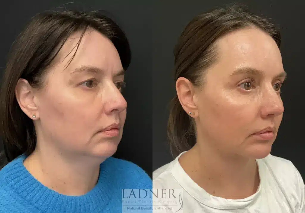 Before and After Image: Blepharoplasty, Minimally Invasive Neck Tightening, and Chin Augmentation - right-front-oblique