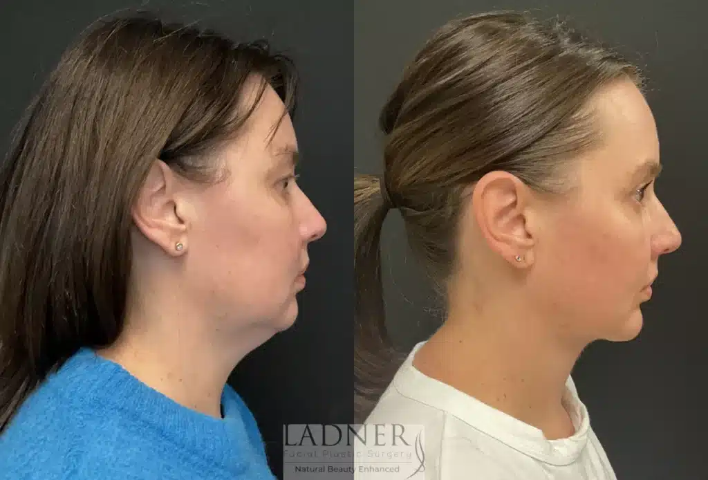 Before and After Image: Blepharoplasty, Minimally Invasive Neck Tightening, and Chin Augmentation - right-side
