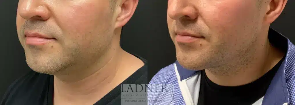 Before and After Image: Minimally Invasive Neck Tightening, Chin Augmentation, and Facial Plastic Surgery for Men - left-front-oblique